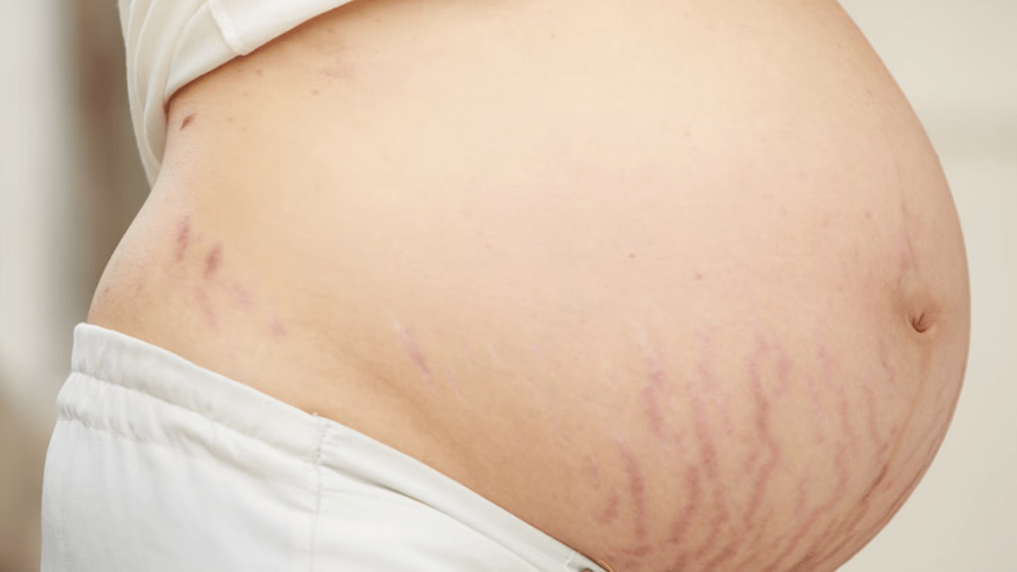 Centella Asiatica - The Wonder Ingredient for Stretch Marks? - GlomamaIndia